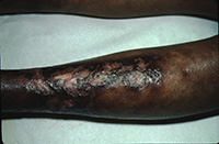 Ulceraration secondary to sarcoidosis